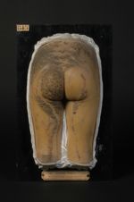 Naevus verruqueux systématisé, ichtyosiforme. Garçon âgé de 5 ans