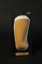 Purpura aigu. Homme âgé de 29 ans