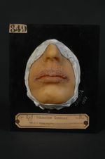 Eczéma orbiculaire chronique des lèvres. Femme âgée de 45 ans