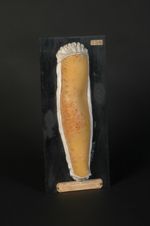 Vaccine. Pustules vaccinales de l'avant-bras, en dehors du siège de la vaccination ; elles s'accompa [...]