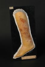 Gommes syphilitiques en nappe ulcérée de la jambe. Femme âgée de 39 ans