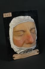 Acné rosée. Couperose variqueuse de la face. Homme âgé de 44 ans