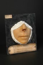 Syphilide tertiaire tuberculo-ulcéreuse (Inv.1922) du nez. Femme âgée de 22 ans (V. le n° 514, même  [...]