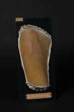 Phthiriase. Mélanodermie phthiriasique. Homme âgé de 67 ans