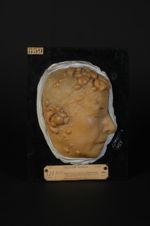 Tumeurs de la face et du cuir chevelu, de nature indéterminée, rappelant l'aspect du cylindrome, mai [...]