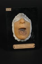 Langue noire, non parasitaire