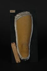 Prurigo de Hebra, chez un jeune sujet (V. le n° 863. bras du même malade)