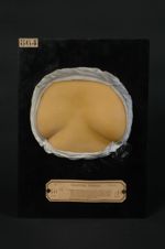 Eczéma séborrhéique figuré présternal. Eczématide figurée (Darier). Dermatose figurée médio-thoraciq [...]