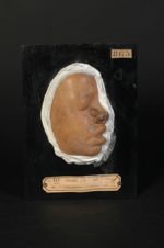 Xeroderma pigmentosum. Jeune fille âgée de 11 ans