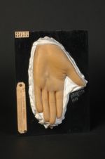 Cheirodactylite syphilitique tertiaire, et rétraction de l'aponévrose palmaire (V. les n° 867, face  [...]