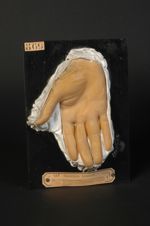 Cheirodactylite syphilitique tertiaire, et rétraction de l'aponévrose palmaire (V. les n° 867, face  [...]