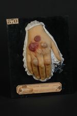 Erythème infectieux à bulles hémorragiques. Femme âgée de 37 ans