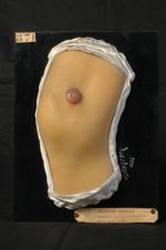 Trichophytie (Inv. 1922) de la cuisse. Homme âgé de 61 ans. Cuisse et genou droit, face interne. Fol [...]