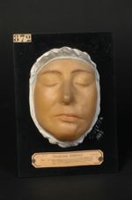 Lupus ulcéreux végétant de la joue et du menton (premier diagnostic : scrofulide verruqueuse végétan [...]