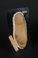 Kératose plantaire avec ulcérations, chez un sclérodermique (Inv. 1922) (V. les n° 580, main du même [...]