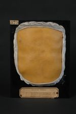 Eczéma séborrhéique, éczématide (Darier), pityriasis stéatoïde (Sabouraud), avec lésions d'étendue v [...]