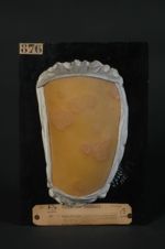 Eczéma séborrhéique, éczématide (Darier), pityriasis stéatoide (Sabouraud) à forme nummulaire (V. le [...]