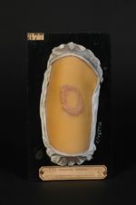 Lupus tuberculo-ulcéreux de la cuisse