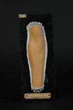 Lichen plan de l'avant-bras. Homme âgé de 45 ans