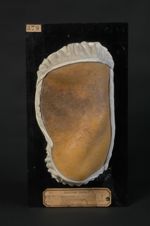Dyskératose folliculaire. Aine gauche et abdomen. Ce moulage a été pris sur la nommée L... F..., par [...]