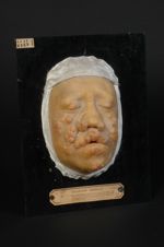 Lèpre tuberculeuse. Garçon âgé de 16 ans. Pays habité : l'île Bourbon (île de la Réunion)