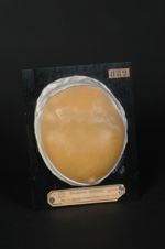 Sclérodermie en plaques ; morphée