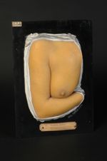 Syphilide papuleuse folliculaire disséminée, du bras et du thorax. Femme âgée de 36 ans