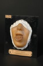 Ulcérations tuberculeuses de la langue. Homme âgé de 23 ans. Tuberculose pulmonaire concomitante