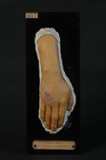 Leishmaniose cutanée (Inv. 1922). Bouton de Biskra. Homme âgé de 26 ans (V. le n° 888 [STLCGE00888], [...]