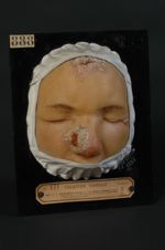 Leishmaniose cutanée (Inv. 1922). Bouton de Biskra. Homme âgé de 26 ans (V. le n° 887 [STLCGE00887], [...]