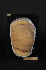 Lupus tuberculo-ulcéreux de la fesse, à marche phagédénique centrifuge