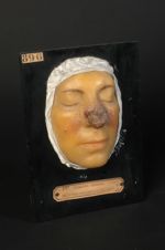 Syphilide tuberculo-gommeuse du nez, simulant le lupus (V. le n° 900, même malade après guérison)