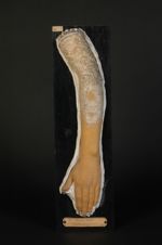 Psoriasis rupiforme ; psoriasis rupioïde. Homme âgé de 41 ans