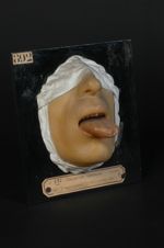 Chancre syphilitique de la langue