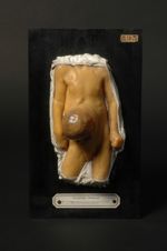 Foetus. Éventration de la région ombilicale chez une fille