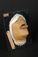 Ulcérations tuberculeuses de la langue