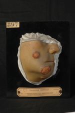 Trichophytie sycosique agminée ; Kérion de Celse. Homme âgé de 60 ans, cocher