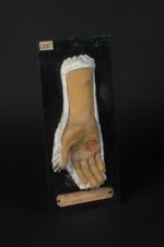 Syphilide ulcéreuse de la paume de la main. Homme âgé de 39 ans