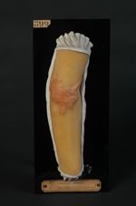 Chéloïde cicatricielle après brûlure du bras. Femme âgée de 34 ans