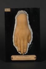 Favus des ongles (onychomycose favique). Jeune fille âgée de 16 ans