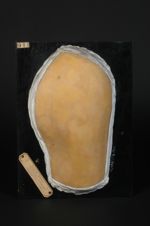 Lèpre maculeuse anesthésique. Femme âgée de 71 ans