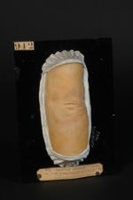 Lèpre maculeuse anesthésique. Femme âgée de 71 ans