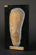 Favus généralisé. Jeune homme âgé de 15 ans (V. le n° 915 [STLCGE00915], dos du même malade)