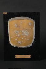 Favus généralisé. Jeune homme âgé de 15 ans (V. le n° 914 [STLCGE00914], cuisse et genou du même mal [...]