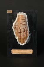 Erythème pellagroïde du dos de la main. Femme âgée de 61 ans