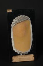 Pityriasis marginé, causé par le microsporon anomoeon, compliqué d'éruption vésiculeuse. (Variété de [...]