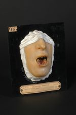Ulcération tuberculeuse de la lèvre inférieure et destruction d'une partie du maxillaire inférieur ; [...]