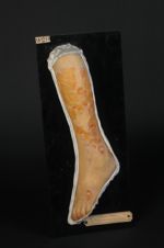 Lèpre ulcéreuse. Pays habité : le Pérou