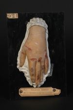 Lèpre ulcéreuse. Pays habité : le Pérou