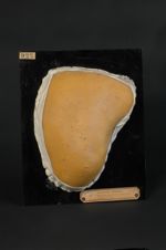 Acné polymorphe, avec prédominance des comédons (Inv. 1922)